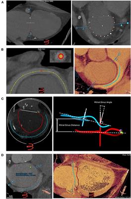 Anatomy and Topography of Coronary Sinus and Mitral Valve Annulus in Functional Mitral Regurgitation